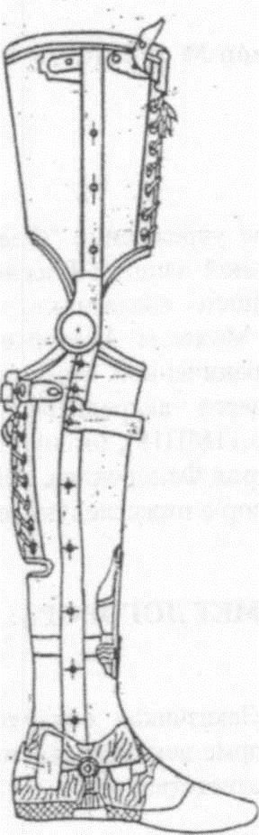 Non-Module Below-Knee Prosthesis for Congenital Deficiency PN-NG