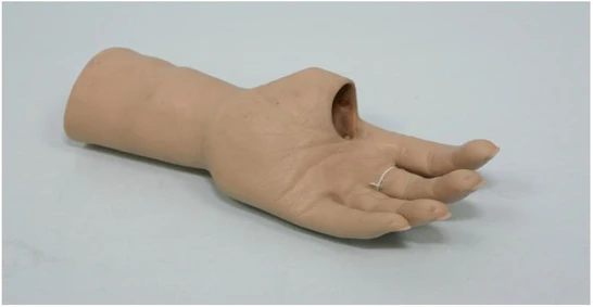الأطراف الصناعية لليد التجميلية لحالات البتر الجزئي والكلي